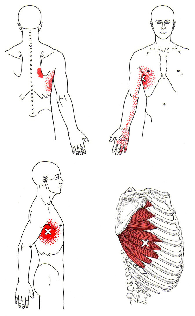 Trigger points of Serratus Anterior, the rounded-shoulder muscle